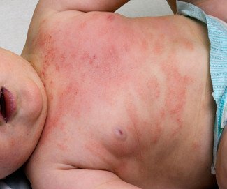 Атопический дерматит — симптомы, причины и лечение атопического дерматита